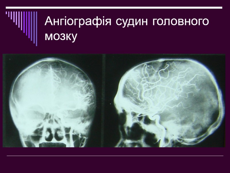 Ангіографія судин головного мозку
